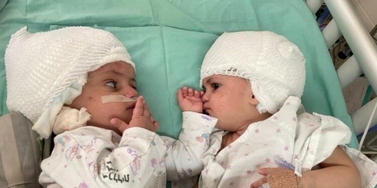 Formerly siamese Israeli twins look at one another after having undergone rare separation surgery at Soroka Medical Centre, Beersheba September 5, 2021. The one-year-old girls, whose names were not released to media, were born with the rear parts of their heads conjoined. Soroka Medical Centre/Handout via REUTERS ATTENTION EDITORS - THIS IMAGE WAS PROVIDED BY A THIRD PARTY.